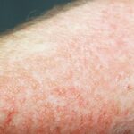 La dermatitis es muy frecuente en verano.